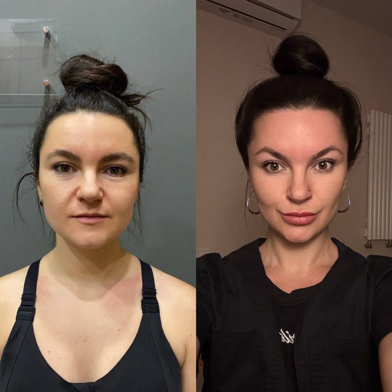 Anastasia önce ve 5 ay sonra