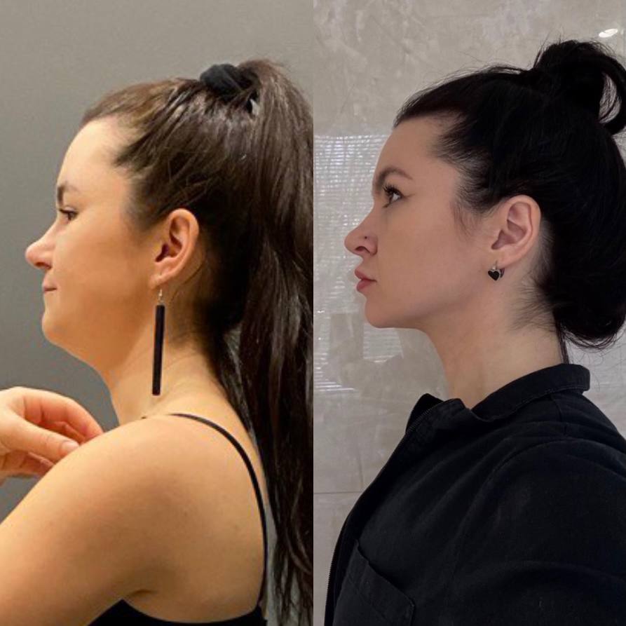 Profil önce/sonra