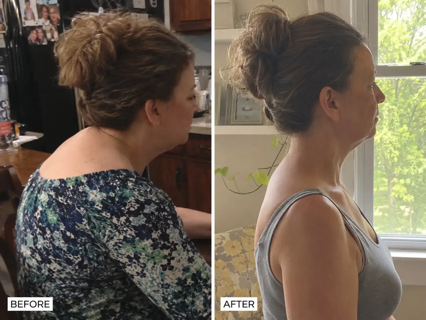 Before and after — posture and hump