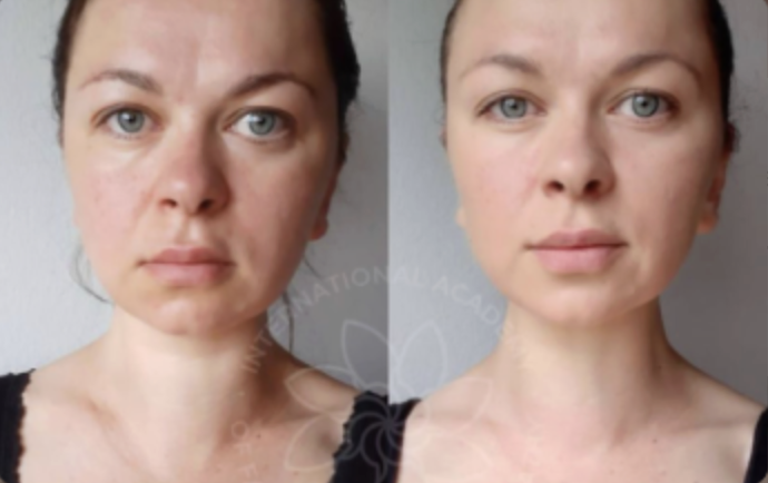 Önce ve sonra — Faceplastica sonucu