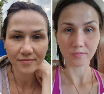 Önce ve sonra — Faceplastica sonucu