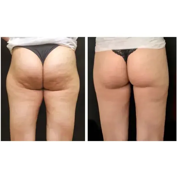 Before and after — smoother thighs
