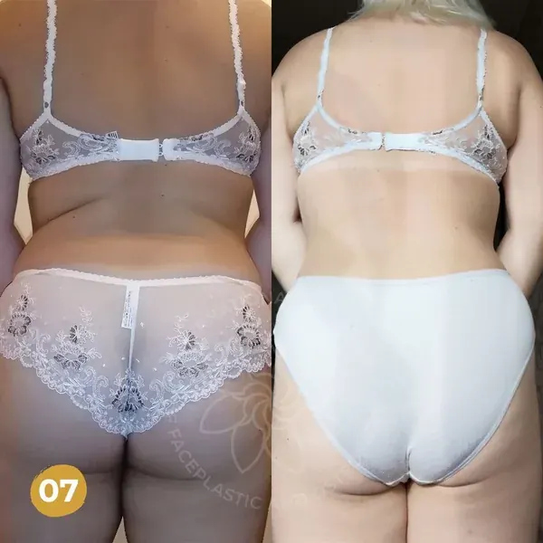 Before and after — bloating settled