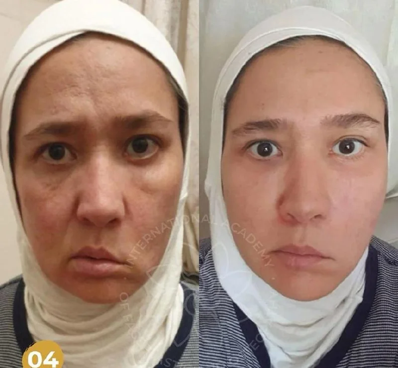 Önce ve sonra — yüz asimetrisi programı sonucu