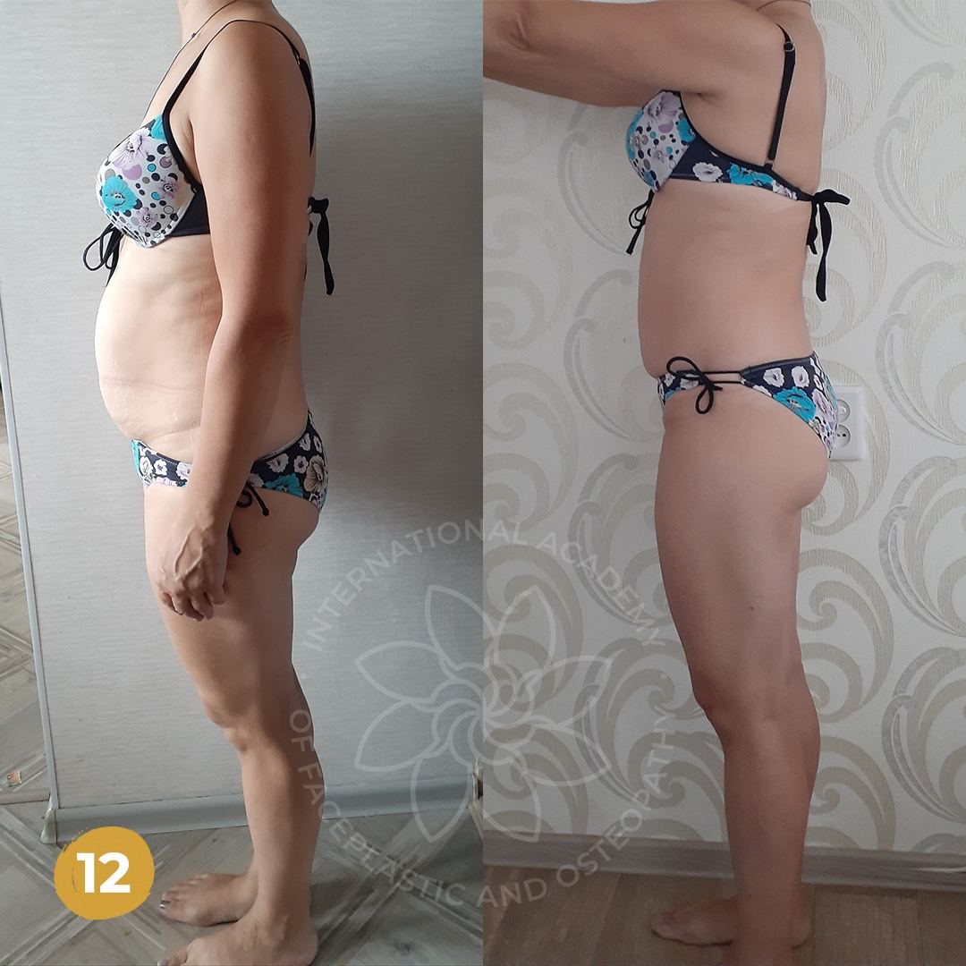 Önce ve sonra — Düz Karın Sistemi sonucu