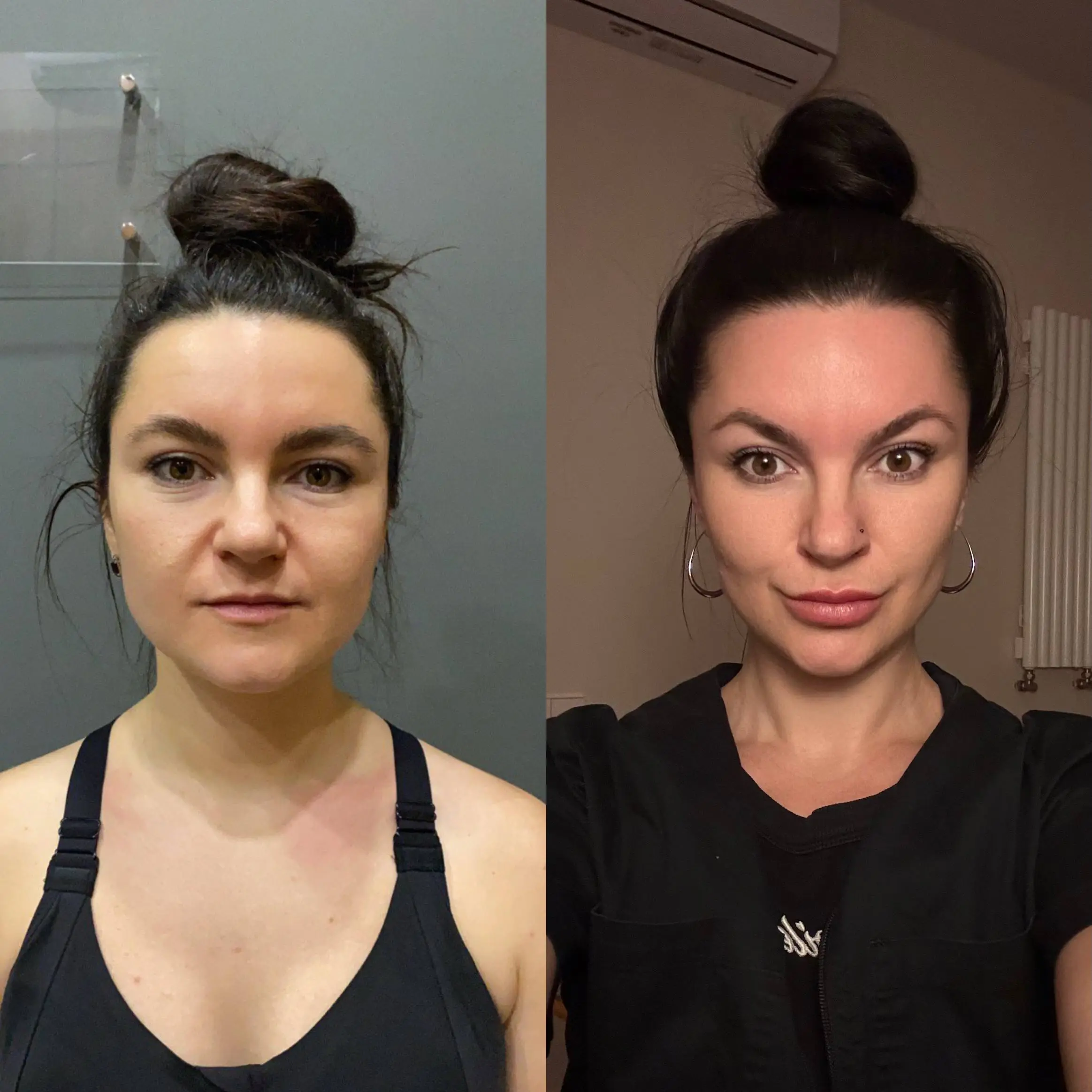 Önce ve sonra — Faceplastica sonucu