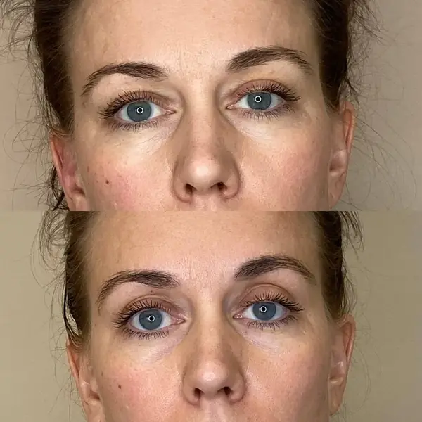 Before and after — less under-eye puffiness after the 10-day Lymphatic Detox
