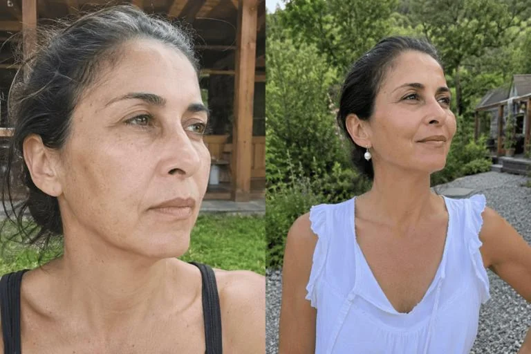 Resultado lifting facial