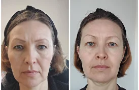Önce ve sonra — Faceplastica sonucu